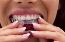 Everything You Need to Know About Clear Aligners Treatment