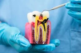 Root Canal Treatment – Save Your Natural Tooth Pain-Free