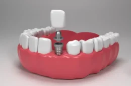 Dental Implants – The Best Solution for Missing Teeth