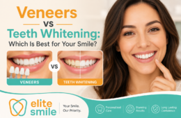 Veneers vs Teeth Whitening: Which Is Best for Your Smile?