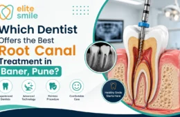 Which Dentist Offers the Best Root Canal Treatment in Baner, Pune?