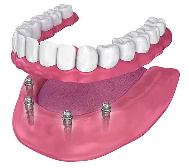 Full Mouth Restoration in Pashan | Complete Smile Care