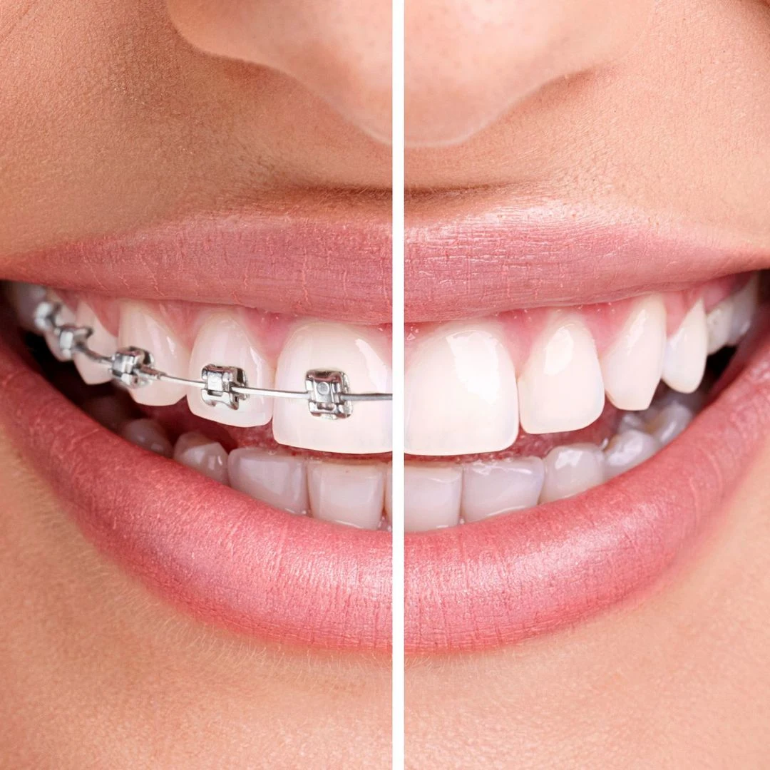 orthodontic treatment in Baner