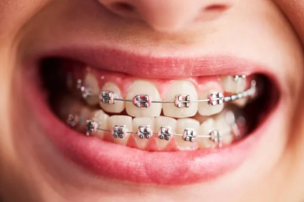 Braces treatment in bavdhan