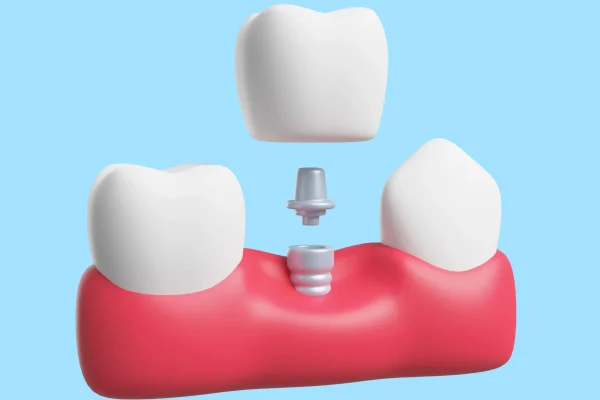 Dental-Bridges-Treatment-in-bavdhan