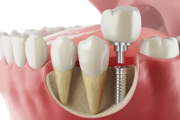 Dental Implant