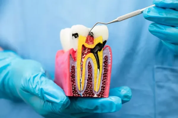 root canal treatment baner