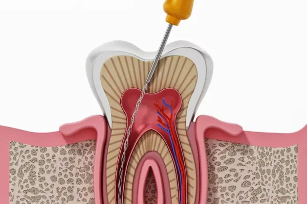 Root-Canal-Treatment-Treatment-in-Bavdhan