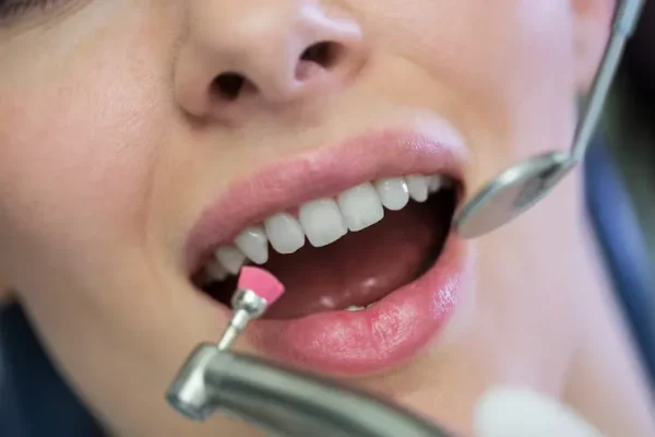 Scaling-and-Polishing-Treatment-in-Bavdhan