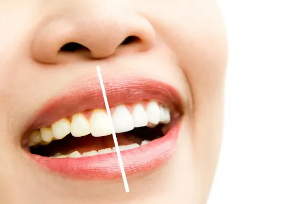 Find Teeth Whitening Treatment in Baner