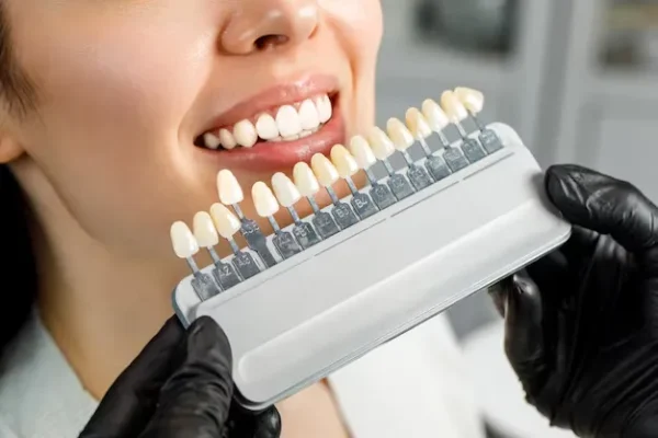 Veneers-Treatment-in-Bavdhan 1