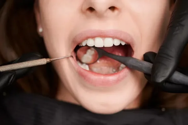 Wisdom-tooth-removal-Treatment-in-Bavdhan1